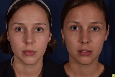 kybella liverpool|I am considering whether to have a lower face lift or Kybella .